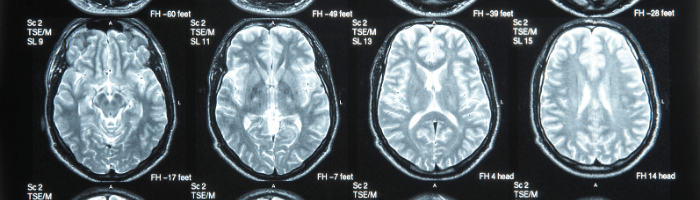 Brain Injury in the Workplace