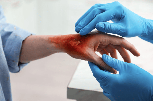 Disfigurement Lawyer in Pennsylvania for Burns, Scars & More