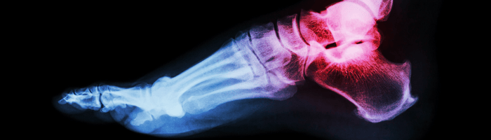 What To Do When You're Hurt at Work